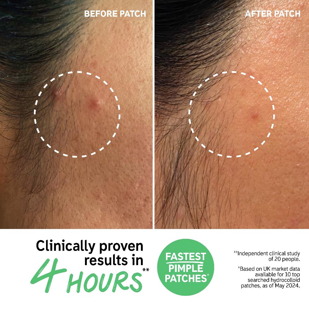 lookfantastic The INKEY List Hydrocolloid Unsichtbarer Pickel-Patches Meist gekauft
